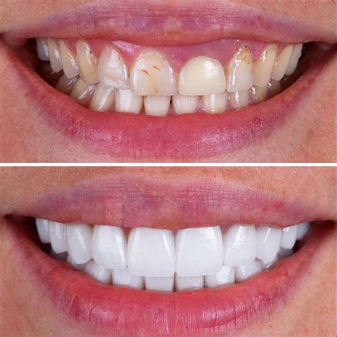 Porcelain Dental Veneers .
